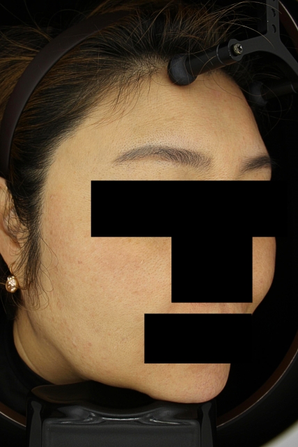 기미·색소 치료 후 사진 03