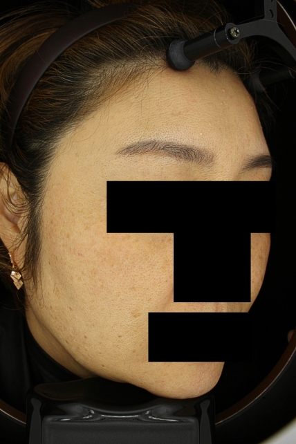 기미·색소 치료 전 사진 03