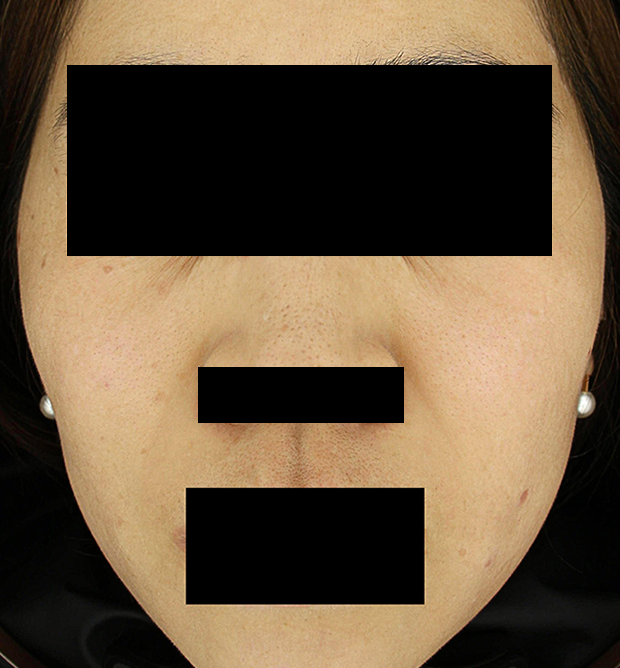 기미·색소 치료 후 대표 사진 81
