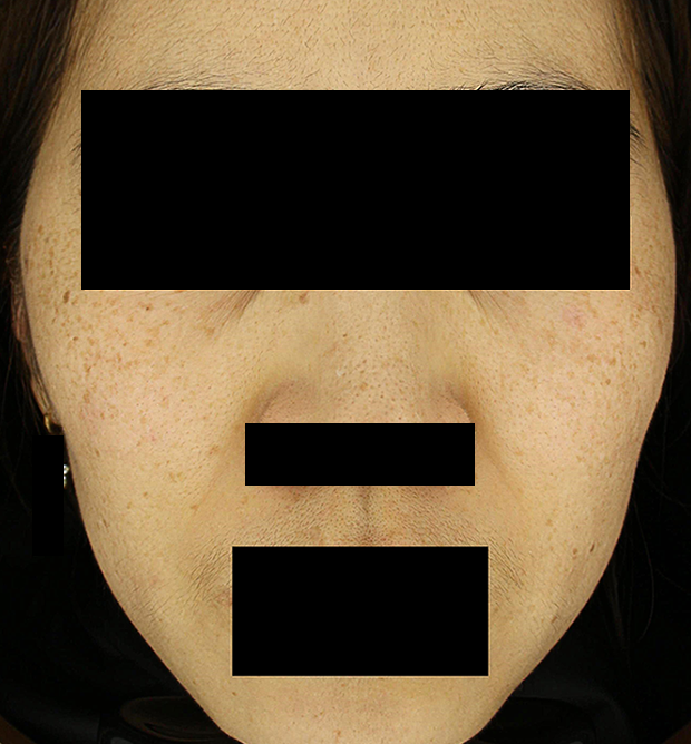 기미·색소 치료 전 대표 사진 81