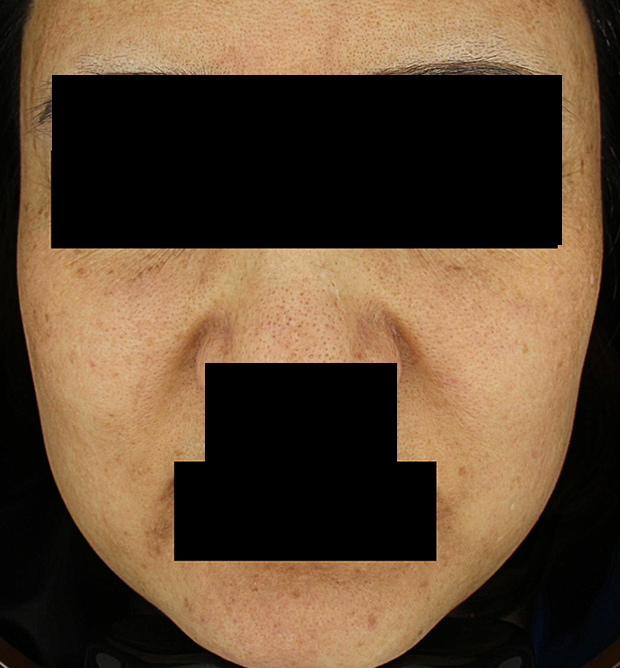 기미·색소 치료 후 대표 사진 83