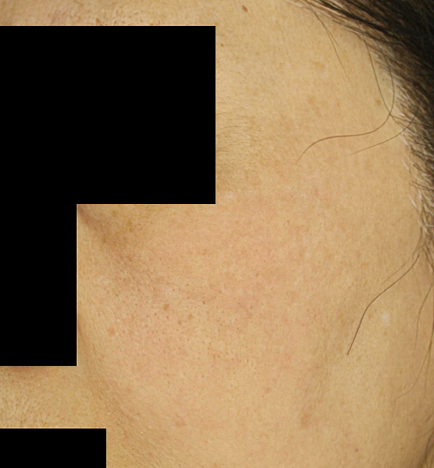기미·색소 치료 후 대표 사진 85