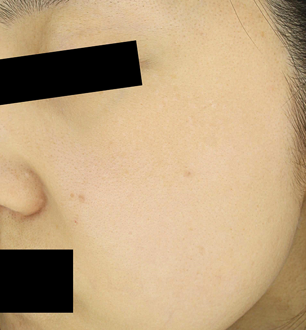기미·색소 치료 후 대표 사진 91