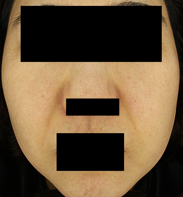 기미·색소 치료 후 대표 사진 94