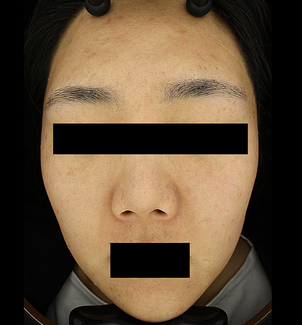기미·색소 치료 후 대표 사진 97