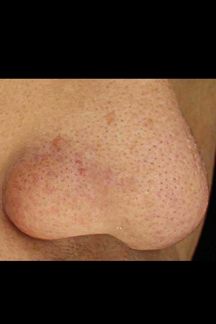 모공 치료 치료 후 대표 사진