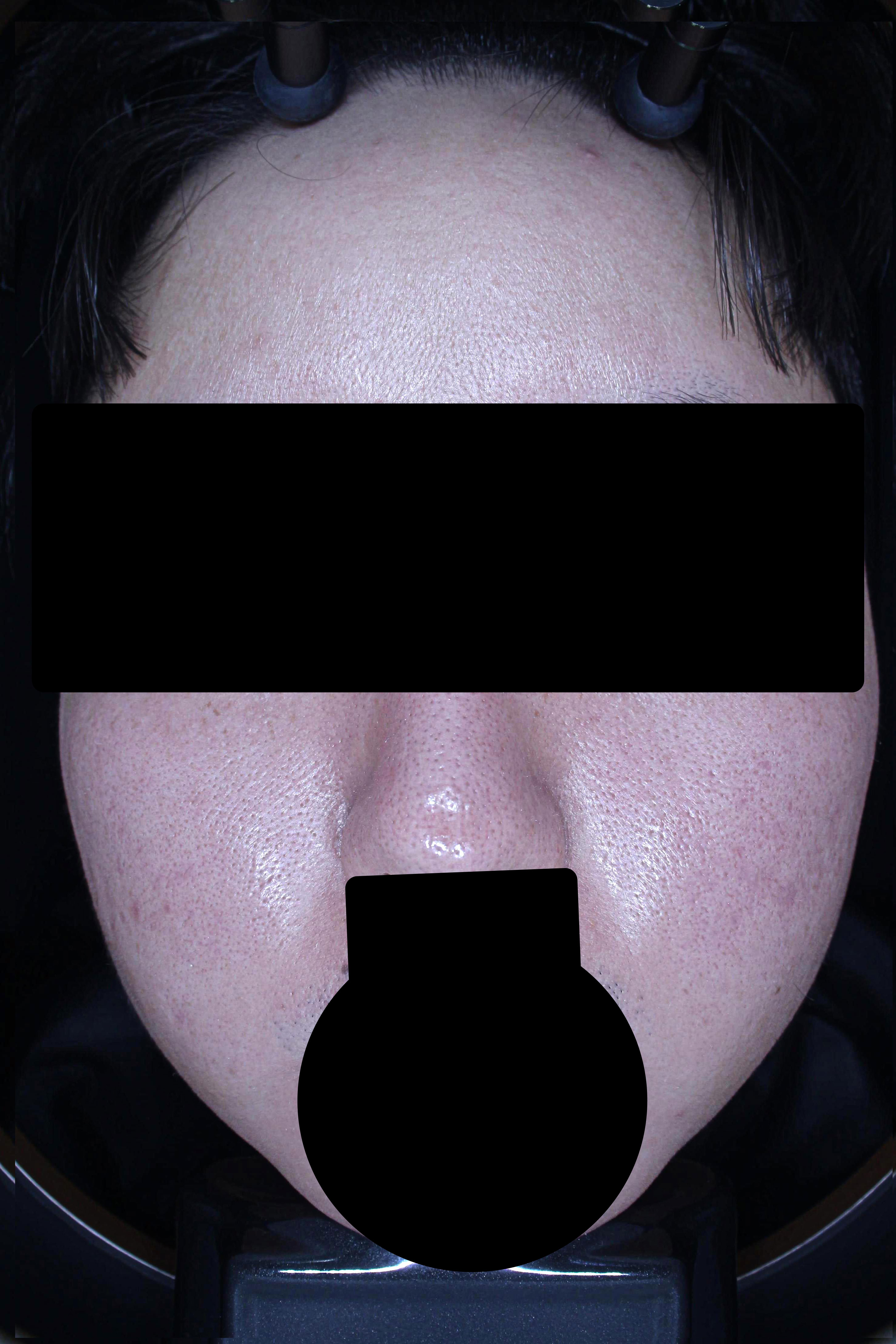 모공 치료 후 대표 사진 03
