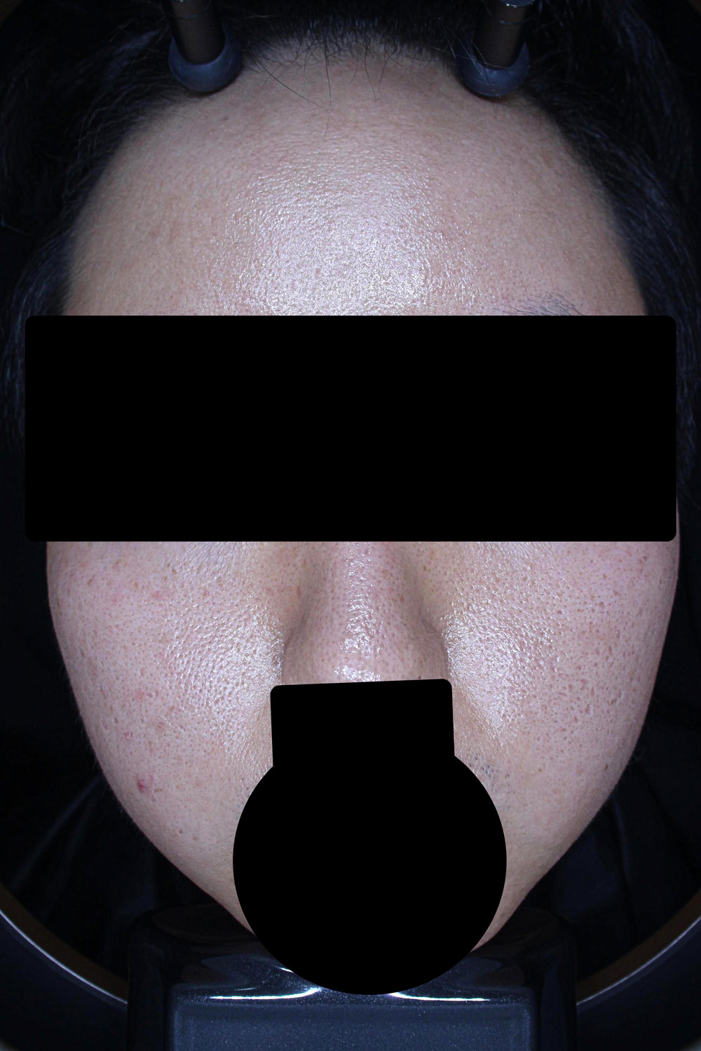 모공 치료 전 대표 사진 03