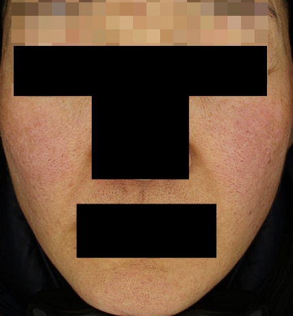 홍조·주사 치료 전 대표 사진 02