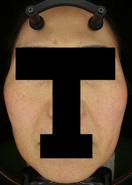 홍조·주사 치료 전 대표 사진 06