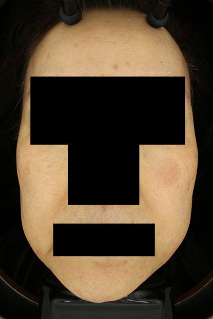 홍조·주사 치료 후 대표 사진 10