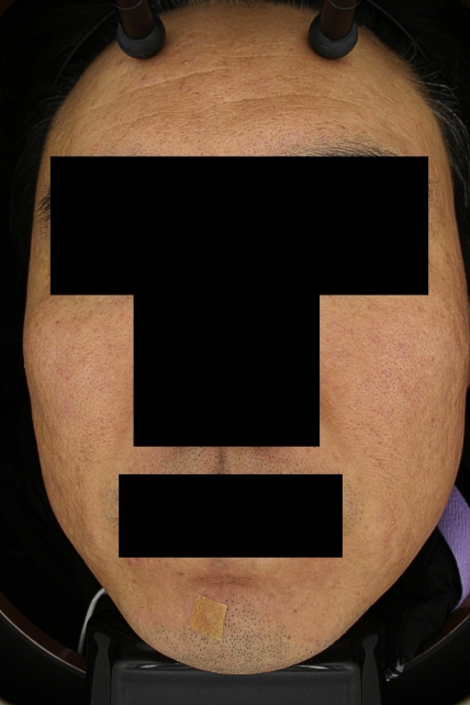 흉터 치료 후 대표 사진 01