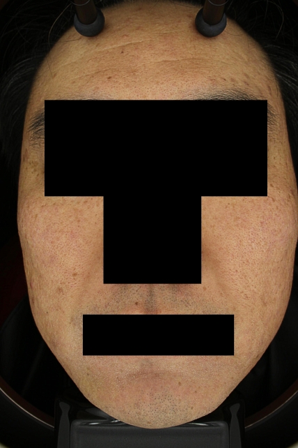 흉터 치료 전 대표 사진 01