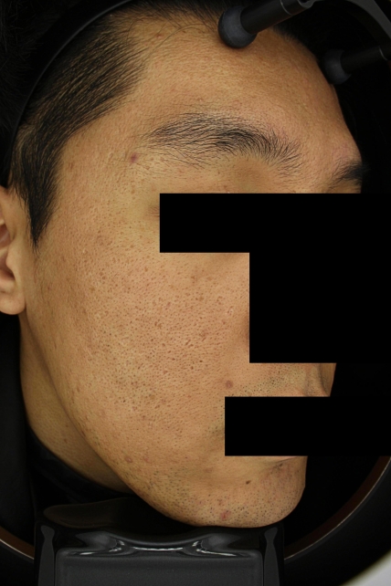 흉터 치료 전 사진 02-03