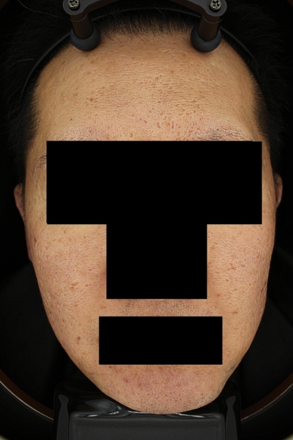 흉터 치료 전 대표 사진 03