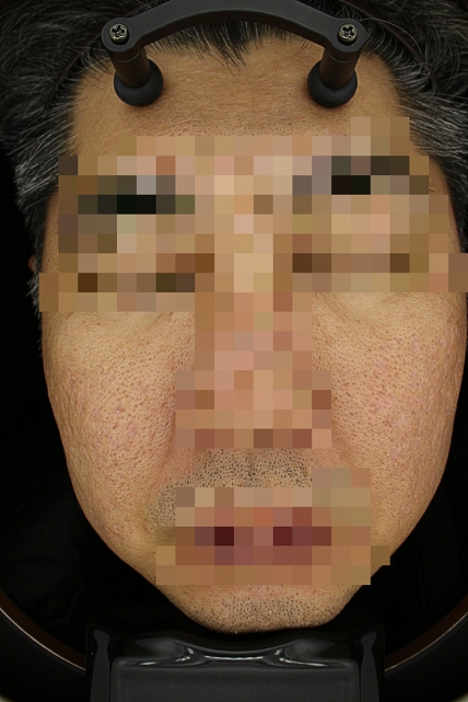 여드름 흉터 치료 치료 후 대표 사진