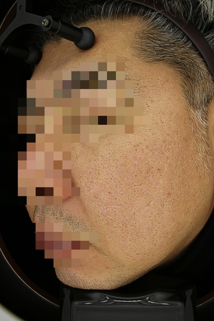 흉터 치료 후 사진 06-02