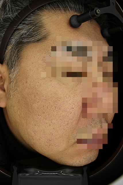 흉터 치료 후 사진 06-03