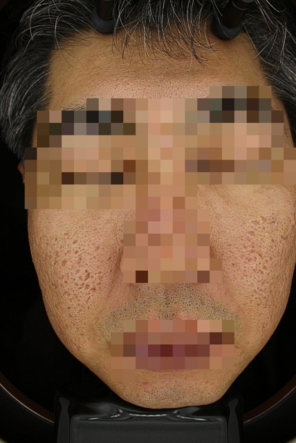 여드름 흉터 치료 치료 전 대표 사진