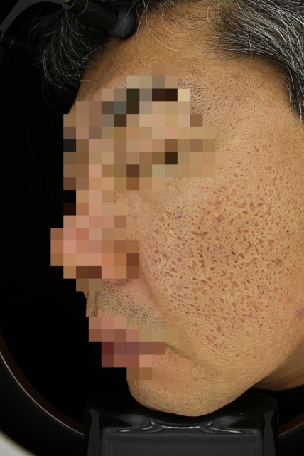 흉터 치료 전 사진 06-02