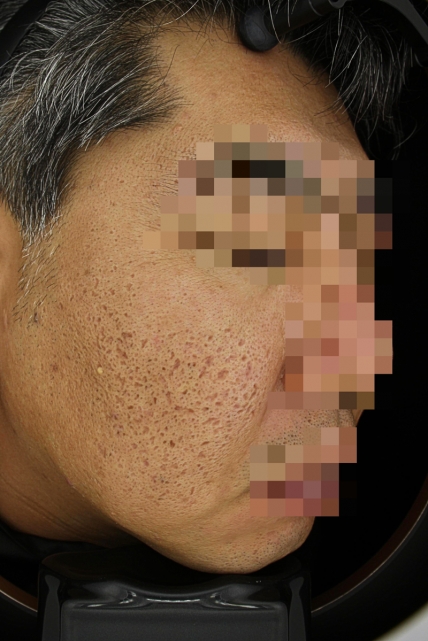 흉터 치료 전 사진 06-03