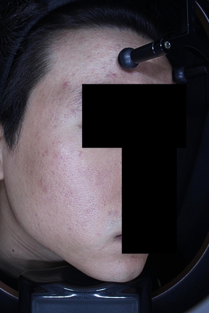 흉터 치료 후 대표 사진 08