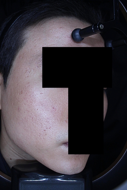 흉터 치료 전 대표 사진 08