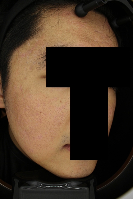 흉터 치료 후 대표 사진 10