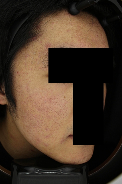 흉터 치료 전 대표 사진 10