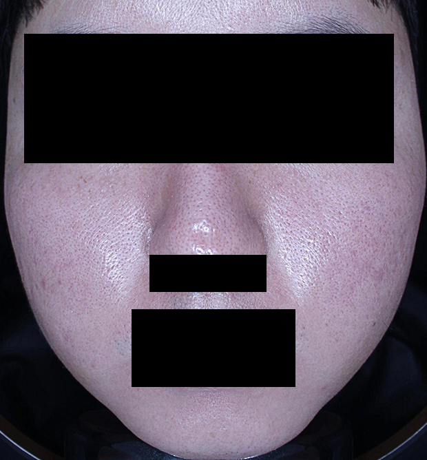 흉터 치료 후 대표 사진 19