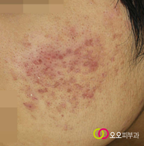 여드름 홍반과 색소침착이 함께 보이는 예시