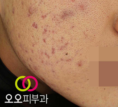 여드름 홍반 예시