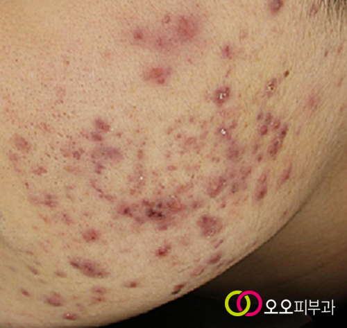 BBL 스케일링 전 여드름 상태