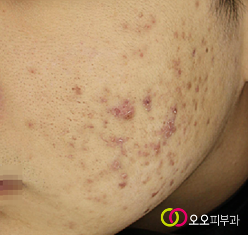 BBL 스케일링 후 중간 경과
