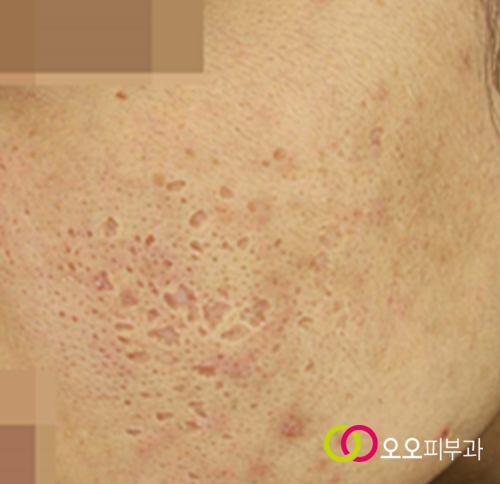 박스카 흉터 예시