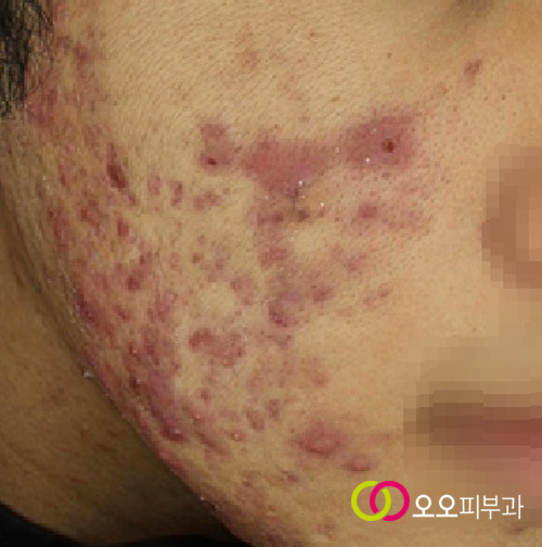 응괴성 낭포성 여드름 예시