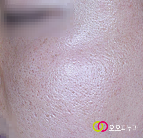아이스픽 흉터 예시