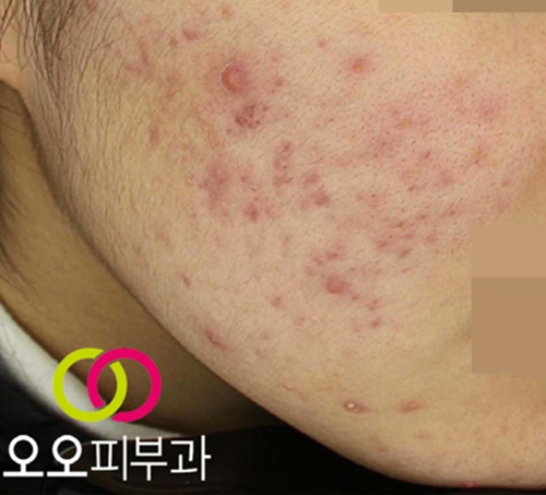구진성 여드름 예시