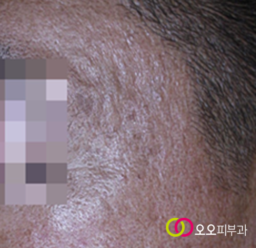 롤링 흉터 예시