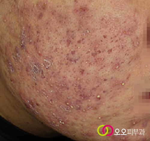 시크릿 알라딘필 치료 전