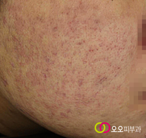 시크릿 알라딘필 치료 중간 경과