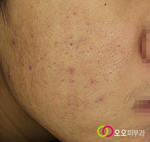 시크릿 알라딘필 치료 후 경과