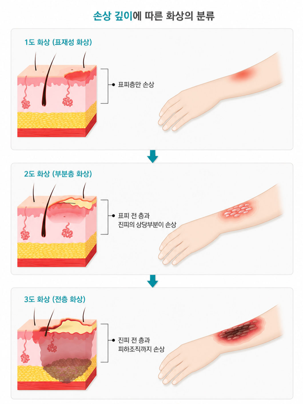 1도 화상 예시