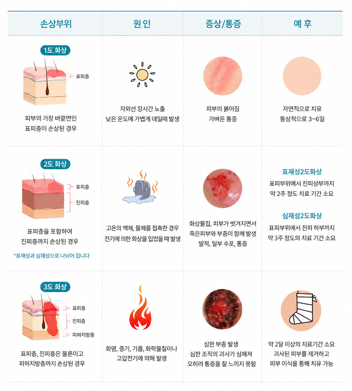 2도 화상 예시
