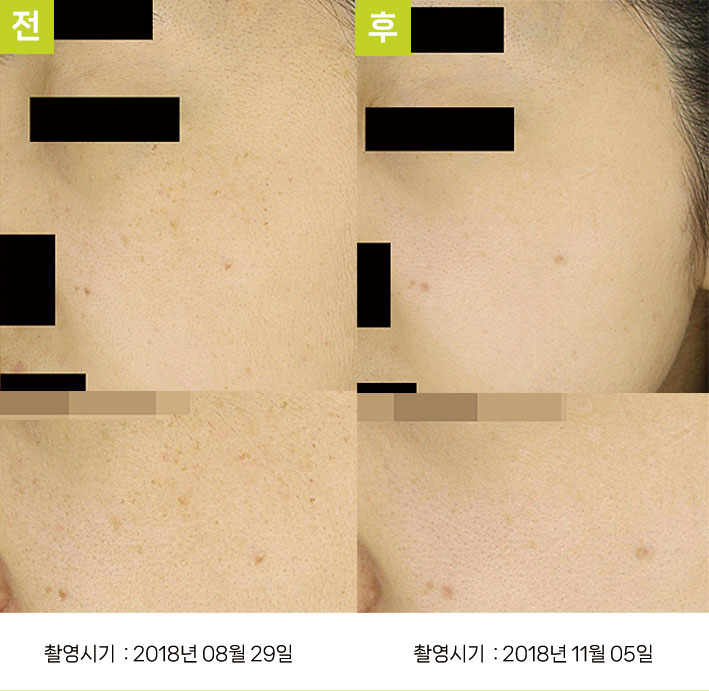 대구주근깨제거 증례1 전후 — 착색이 잘 생기는 예민한 피부 오오색소토닝 10회 대구주근깨레이저