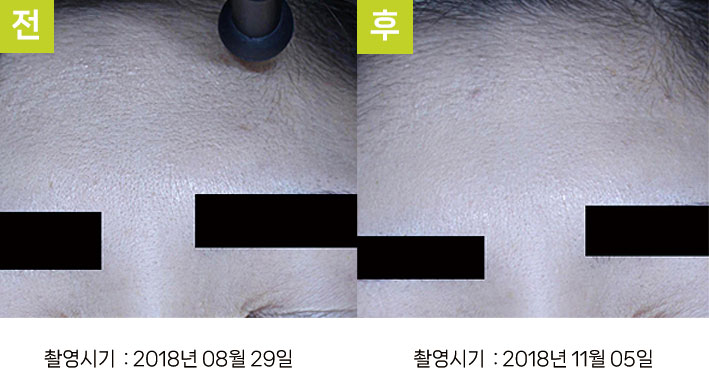 대구주근깨레이저 증례2 전후 — 오오색소토닝 후 피부결 잔주름 개선 광택광 비교