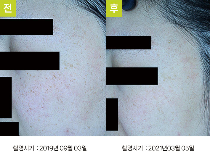 대구주근깨제거 증례3 전후 — BBL 초벌 후 오오색소토닝 10회 주근깨 호전