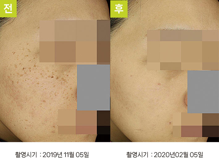 주근깨 증례3 전후 ② — BBL 초벌 + 오오색소토닝 10회 대구주근깨레이저