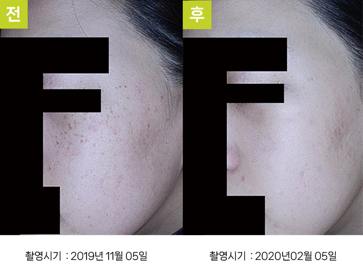 주근깨 증례3 전후 ③ — 18개월 불규칙 시술 BBL 초벌 + 오오색소토닝