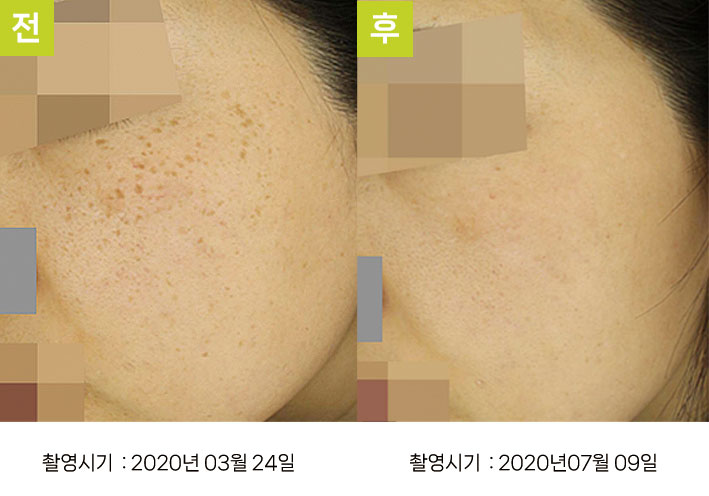 대구주근깨피부과 증례4 전후 — 오오집중색소치료프로그램 1사이클 주근깨 호전